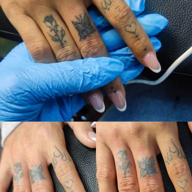 Eliminación de tatuaje con el láser Neatcell 🌟 - Img 113272130