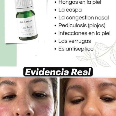 Sérum de Tea Tree para el acné, resequedad y caspa, elimina los hongos  ayuda a eliminar verrugas - Img 118621757