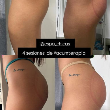 VACUMTERAPIA DE GLÚTEOS CON COPAS COLOMBIANAS EN LA HABANA  ¿Quieres mejorar la apariencia de tus glúteos? ✨  En Espa Ch - 3/3